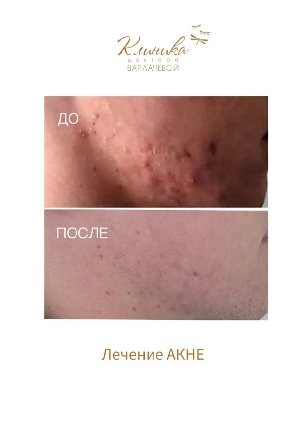 Фото до и после процедуры лечения акне в акции ноября 2023 года в клинике доктора Варлачевой.